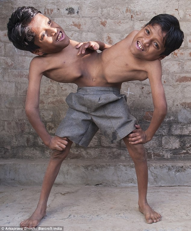  Сиамские близнецы, считающиеся индийским божеством 