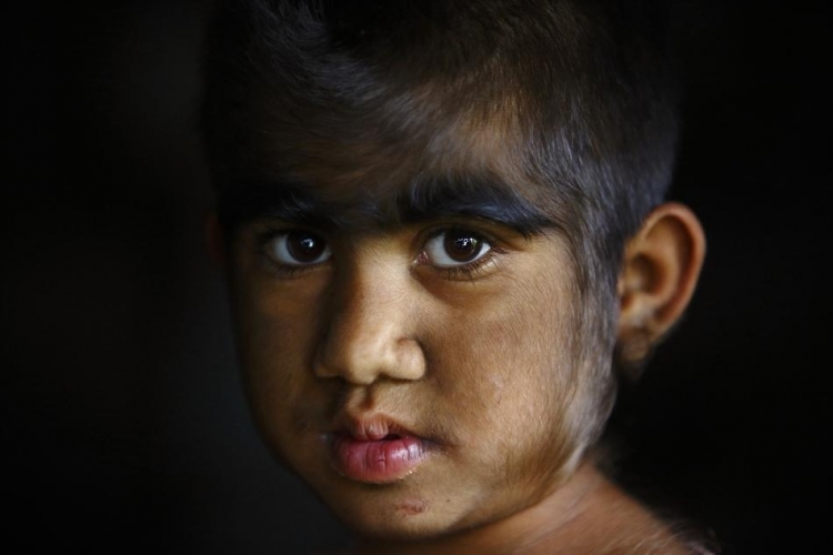 Семья оборотней из Непала обрела человеческий облик 