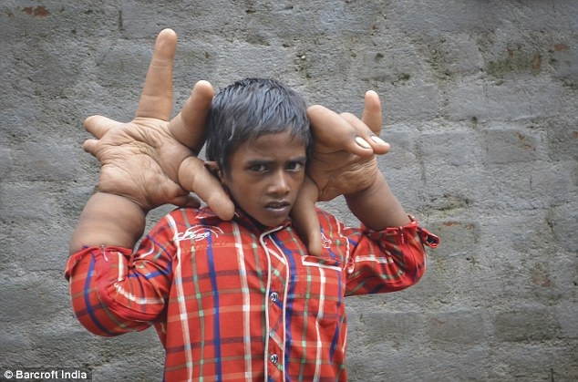 Индийский мальчик с гигантскими руками 