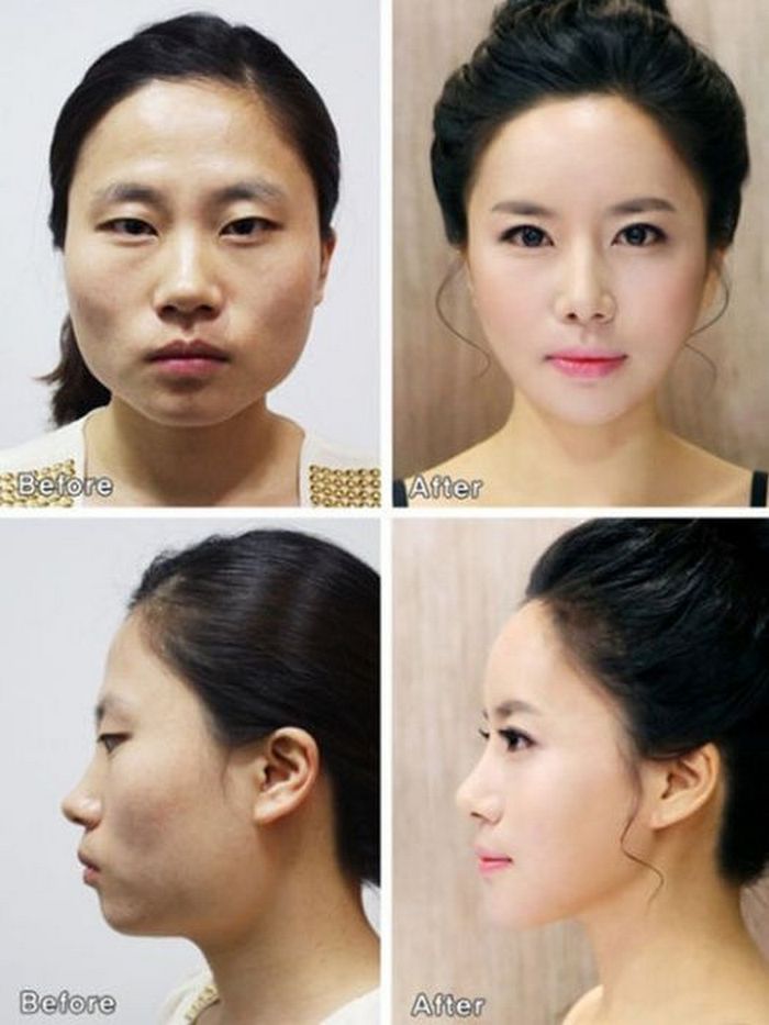 Корейская пластическая хирургия "до и после" 