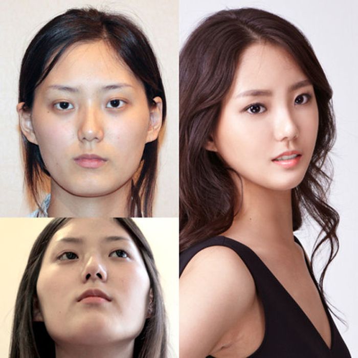 koreian_plastic_surgery_before_after_29. 