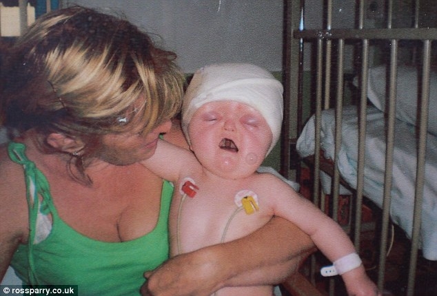 Синдром Аперта превратил ребенка в "сломанную куклу" 